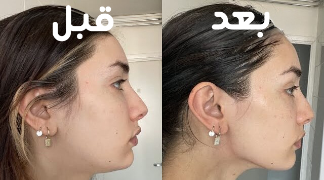 قبل و بعد گواشا