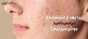 چرا بعد از استفاده از نیاسینامید جوش میزنیم؟