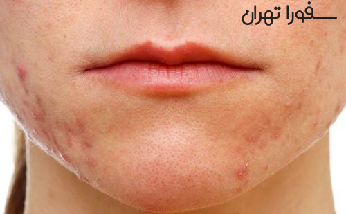 چرا بعد استفاده از نیاسینامید جوش میزنم؟